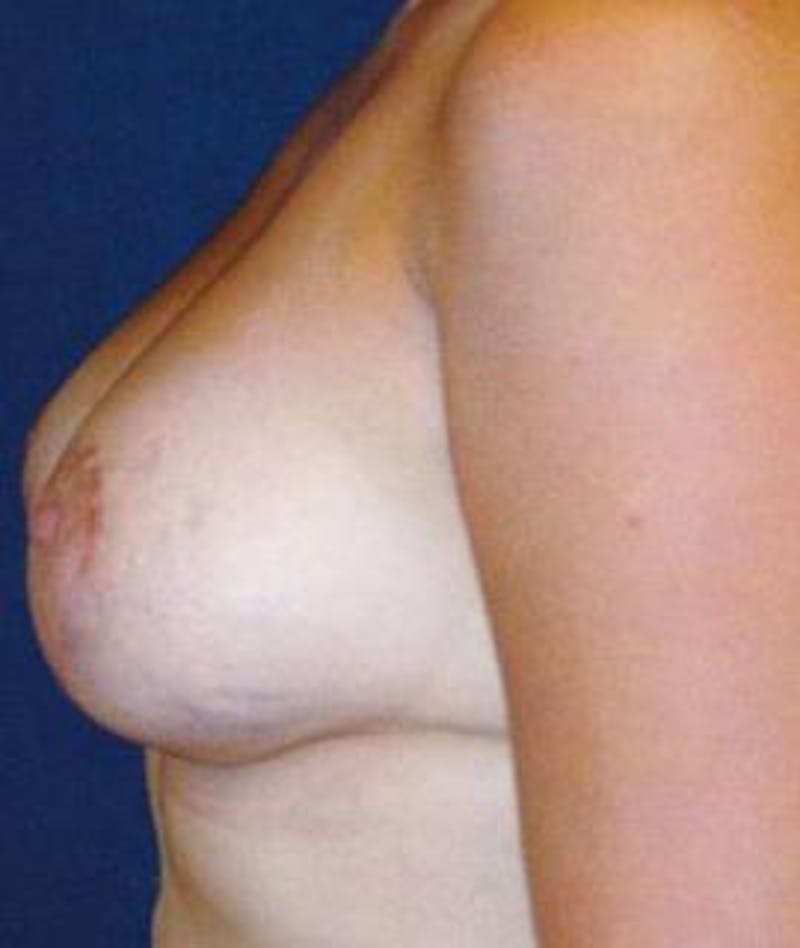 Breast Lift Before & After Gallery - Patient 433574 - Image 4