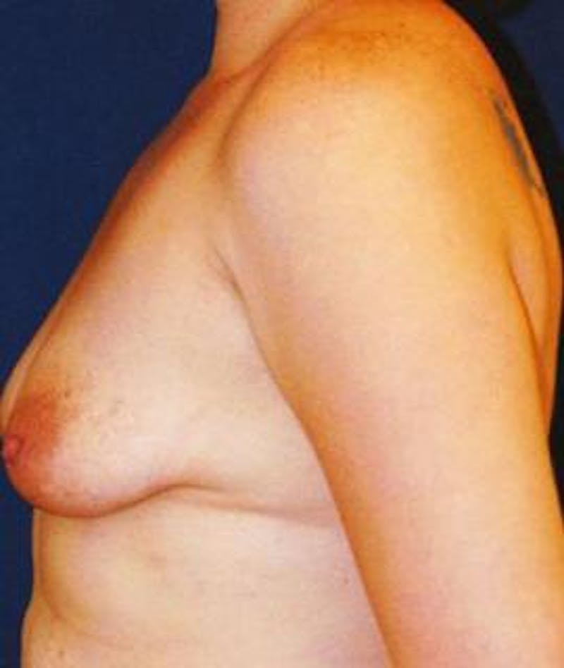 Breast Lift Before & After Gallery - Patient 433574 - Image 3