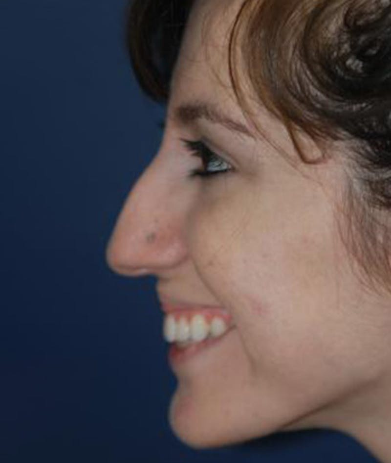 Rhinoplasty Before & After Gallery - Patient 165912 - Image 1