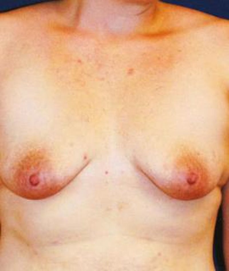Breast Lift Before & After Gallery - Patient 433574 - Image 1