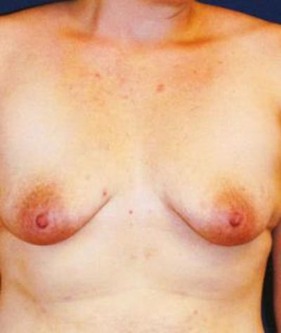 Breast Lift Before & After Gallery - Patient 433574 - Image 1