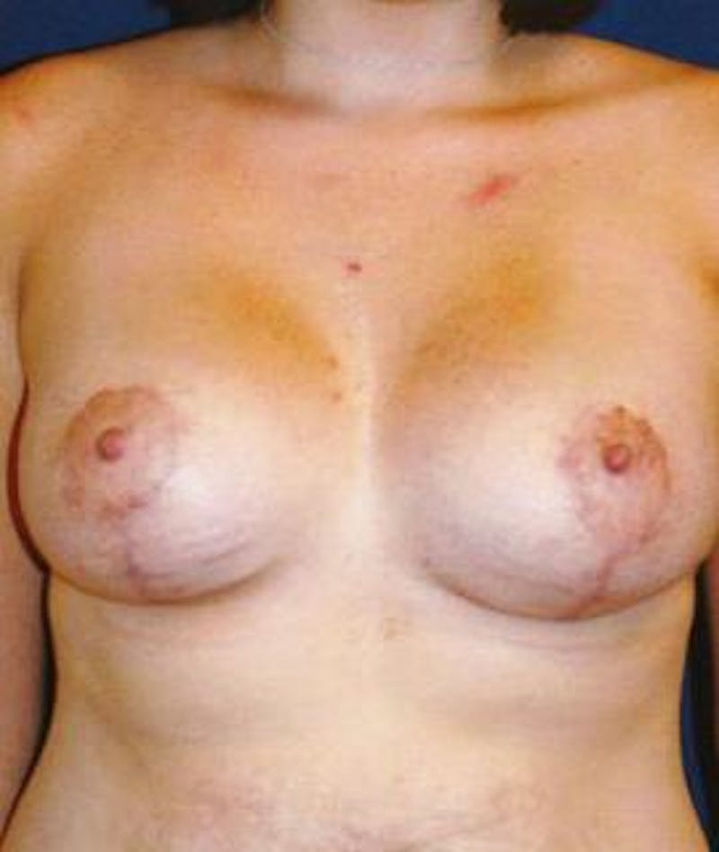 Breast Lift Before & After Gallery - Patient 433574 - Image 2