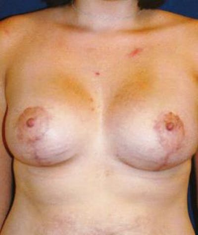 Breast Lift Before & After Gallery - Patient 433574 - Image 2