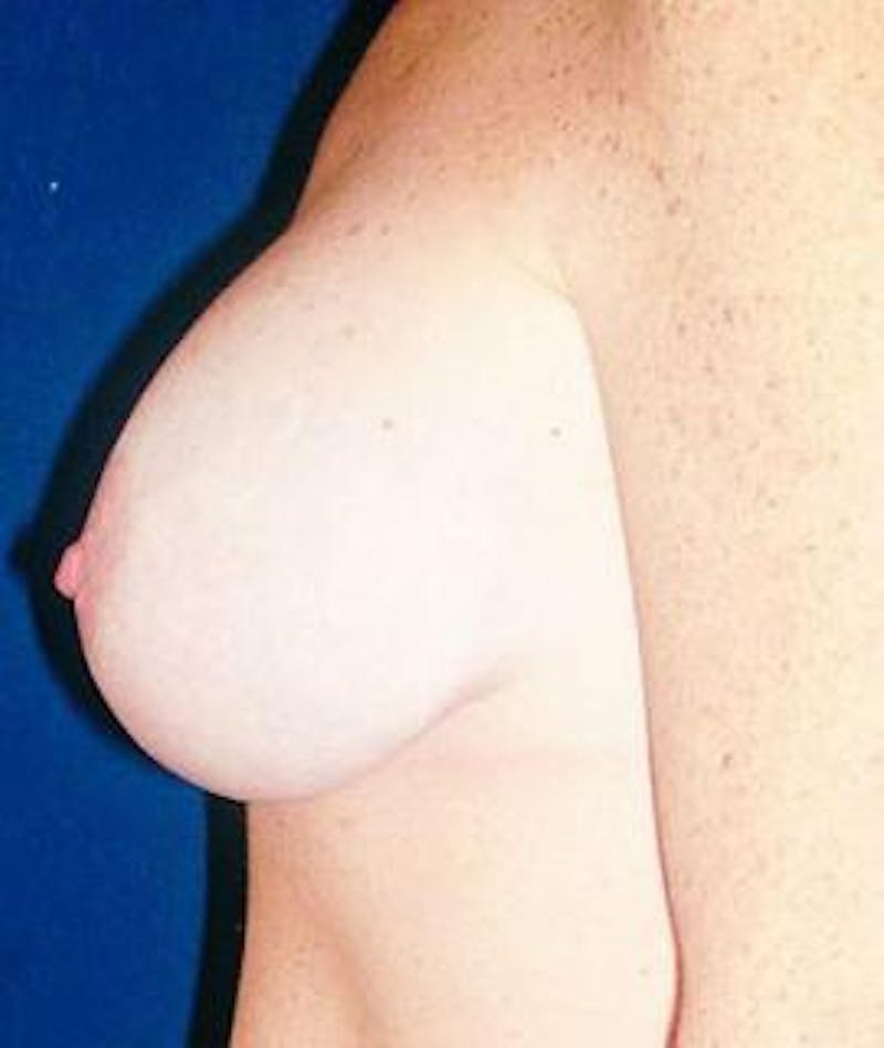 Breast Lift Before & After Gallery - Patient 131577 - Image 2