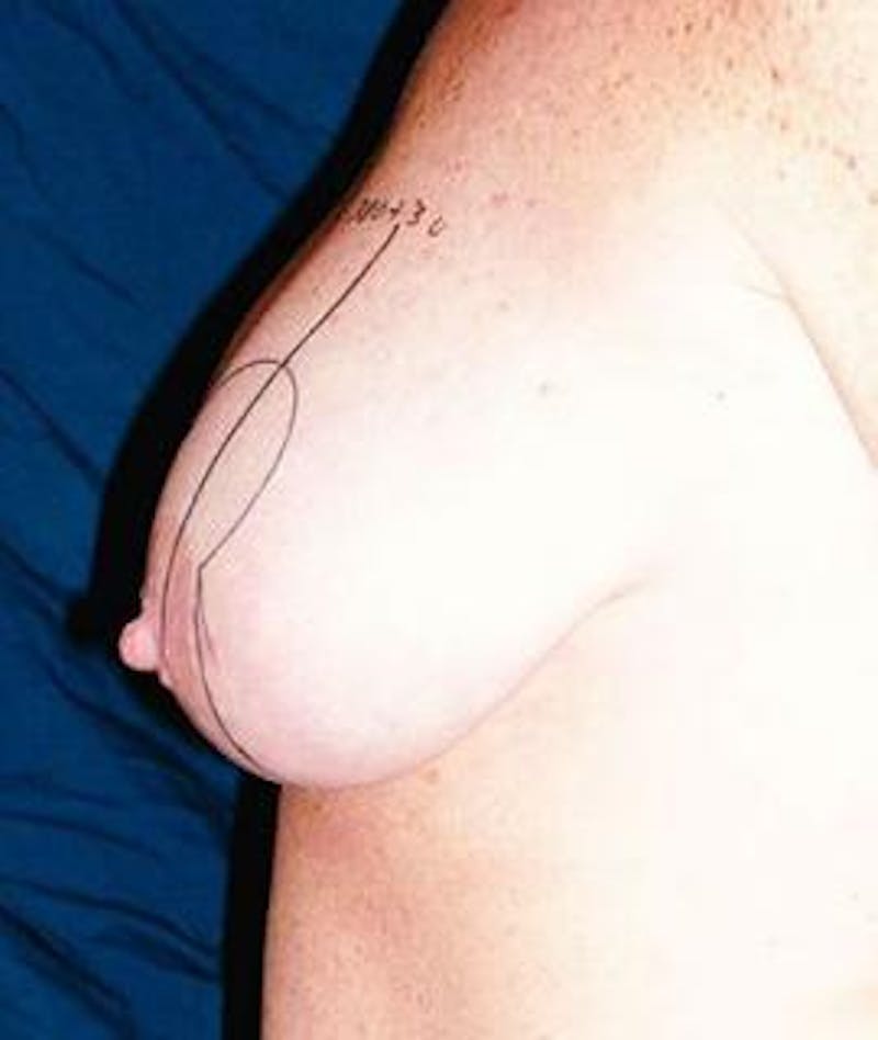 Breast Lift Before & After Gallery - Patient 131577 - Image 1