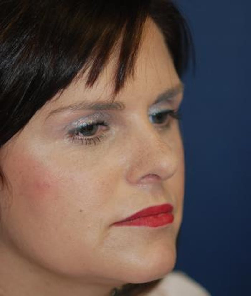 Rhinoplasty Before & After Gallery - Patient 251537 - Image 6