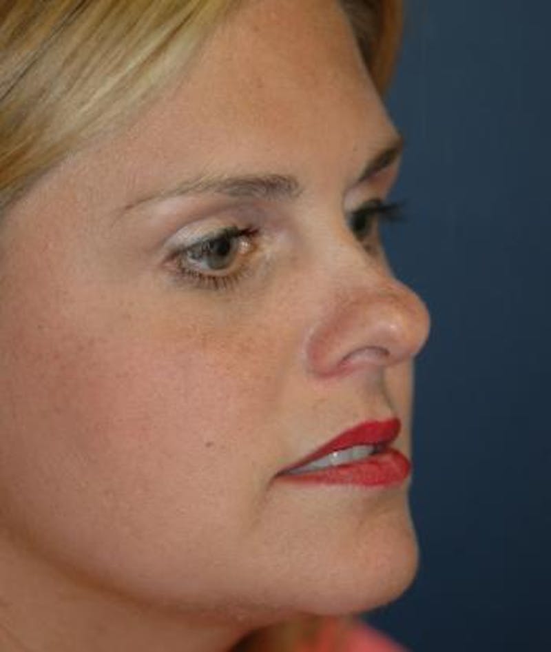 Rhinoplasty Before & After Gallery - Patient 251537 - Image 5
