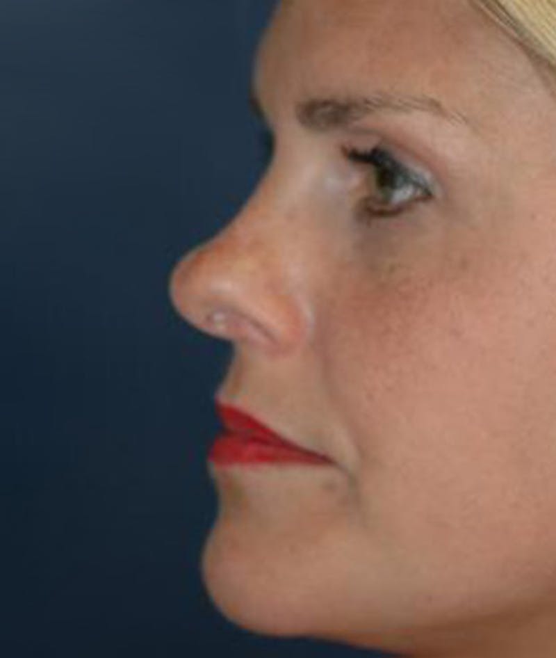 Rhinoplasty Before & After Gallery - Patient 251537 - Image 3
