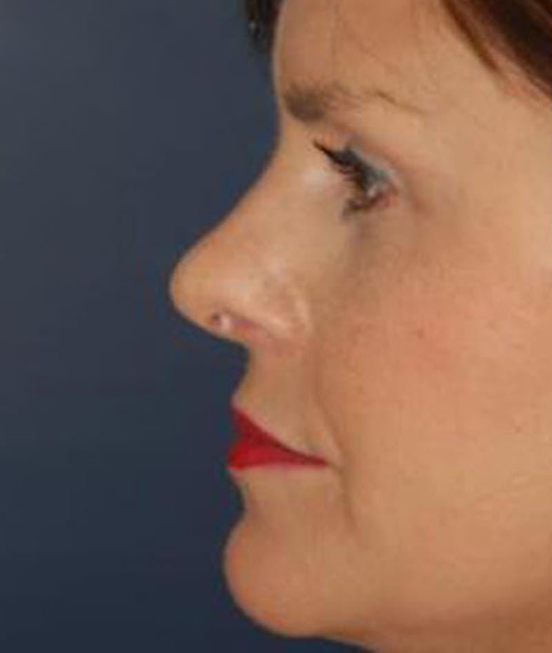 Rhinoplasty Before & After Gallery - Patient 251537 - Image 4