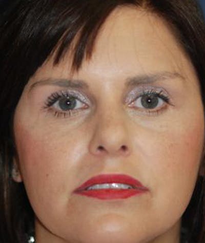 Rhinoplasty Before & After Gallery - Patient 251537 - Image 2
