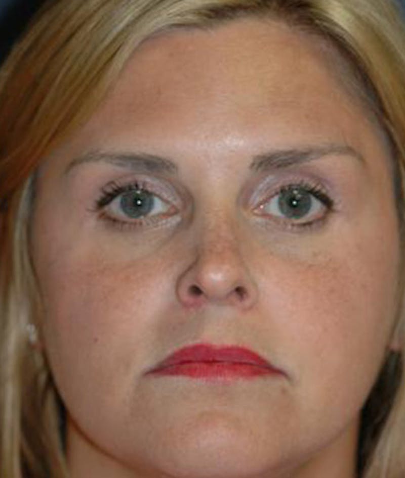 Rhinoplasty Before & After Gallery - Patient 251537 - Image 1