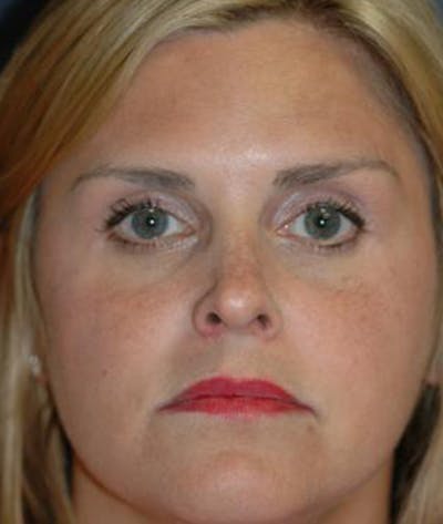 Rhinoplasty Before & After Gallery - Patient 251537 - Image 1