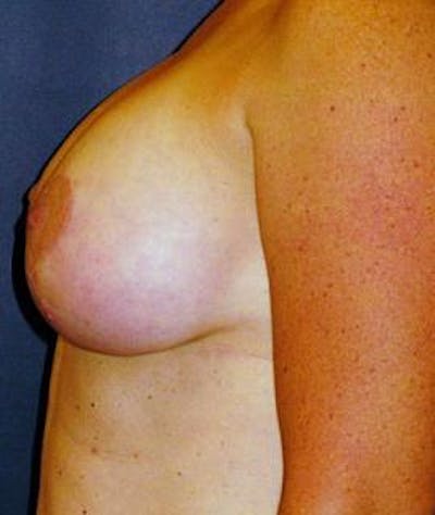 Breast Lift Before & After Gallery - Patient 452313 - Image 2