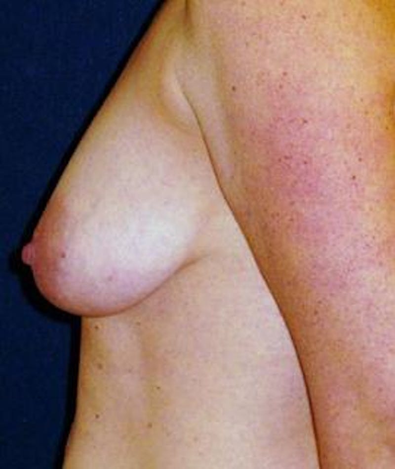 Breast Lift Before & After Gallery - Patient 452313 - Image 1