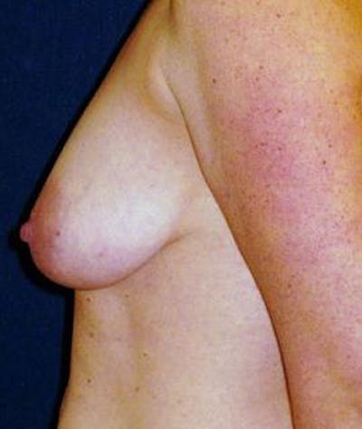 Breast Lift Before & After Gallery - Patient 452313 - Image 1