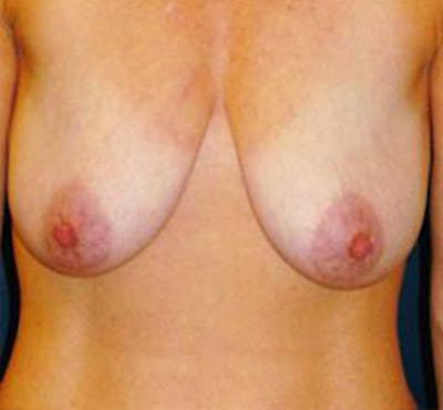 Breast Lift Before & After Gallery - Patient 139517 - Image 1