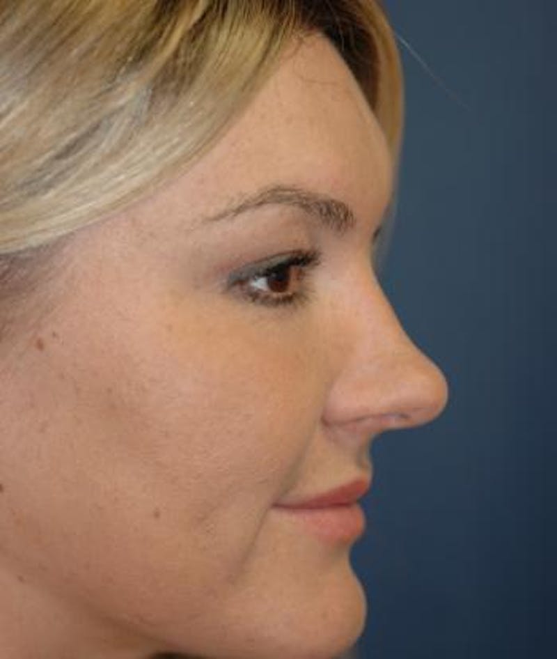 Rhinoplasty Before & After Gallery - Patient 334940 - Image 3