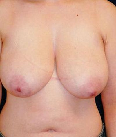 Breast Lift Before & After Gallery - Patient 328488 - Image 1