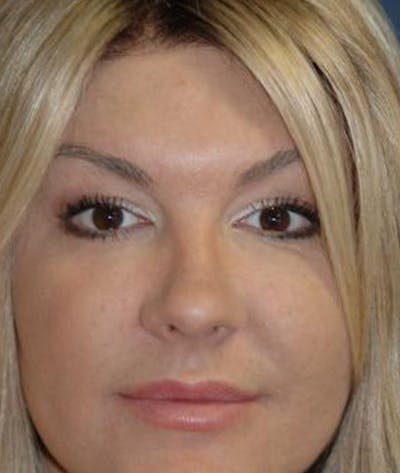 Rhinoplasty Before & After Gallery - Patient 334940 - Image 1