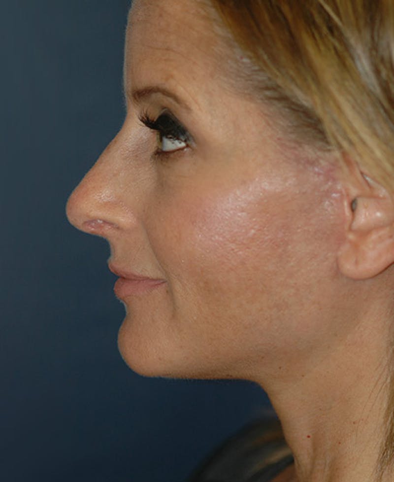 Facelift Before & After Gallery - Patient 228132 - Image 6