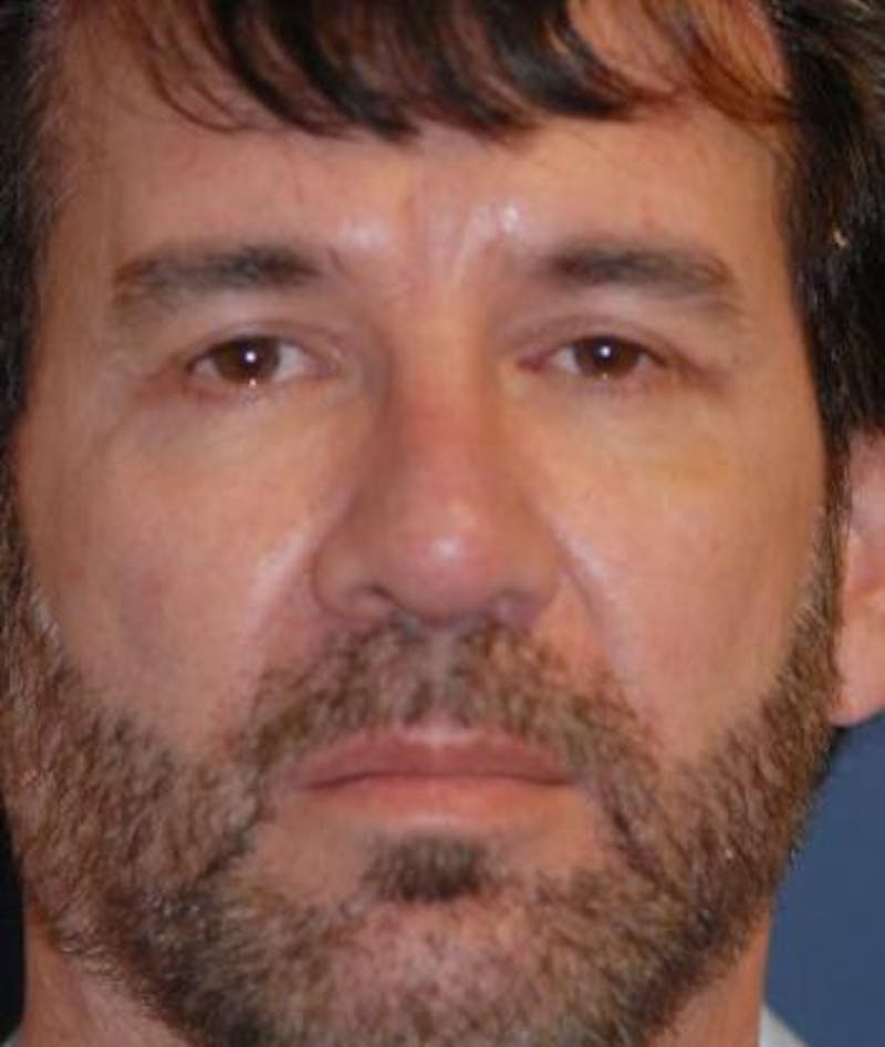 Rhinoplasty Before & After Gallery - Patient 973918 - Image 4