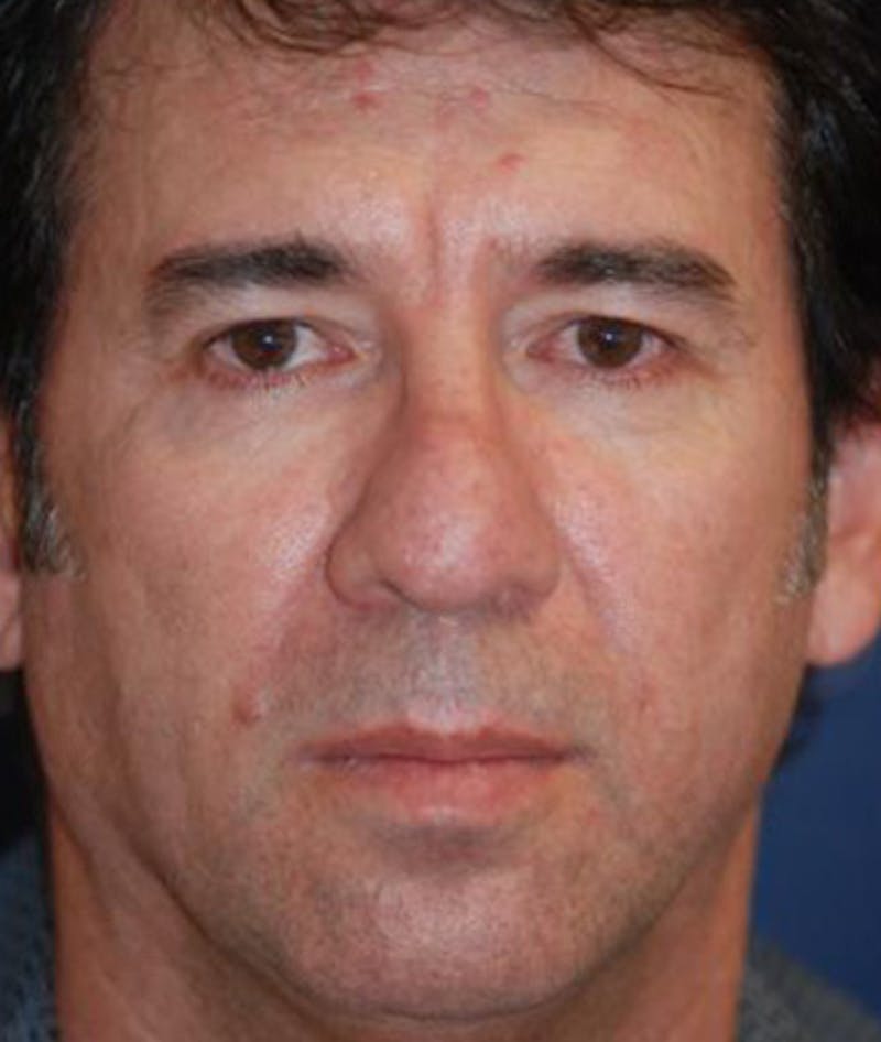 Eyelid Lift (Blepharoplasty) Before & After Gallery - Patient 270010 - Image 1