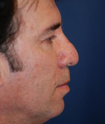 Rhinoplasty Before & After Gallery - Patient 973918 - Image 1
