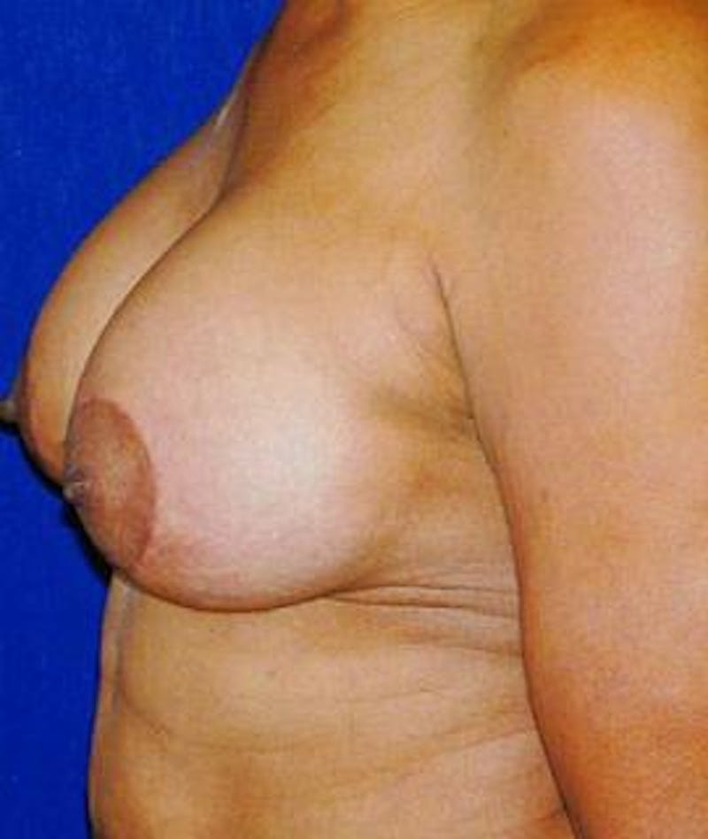 Breast Lift Before & After Gallery - Patient 116478 - Image 4