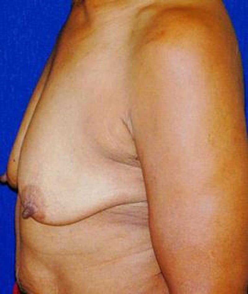 Breast Lift Before & After Gallery - Patient 116478 - Image 3