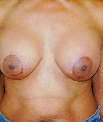 Breast Lift Before & After Gallery - Patient 116478 - Image 2