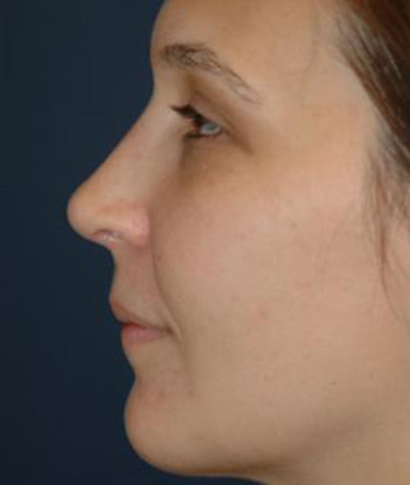 Rhinoplasty Before & After Gallery - Patient 297607 - Image 6