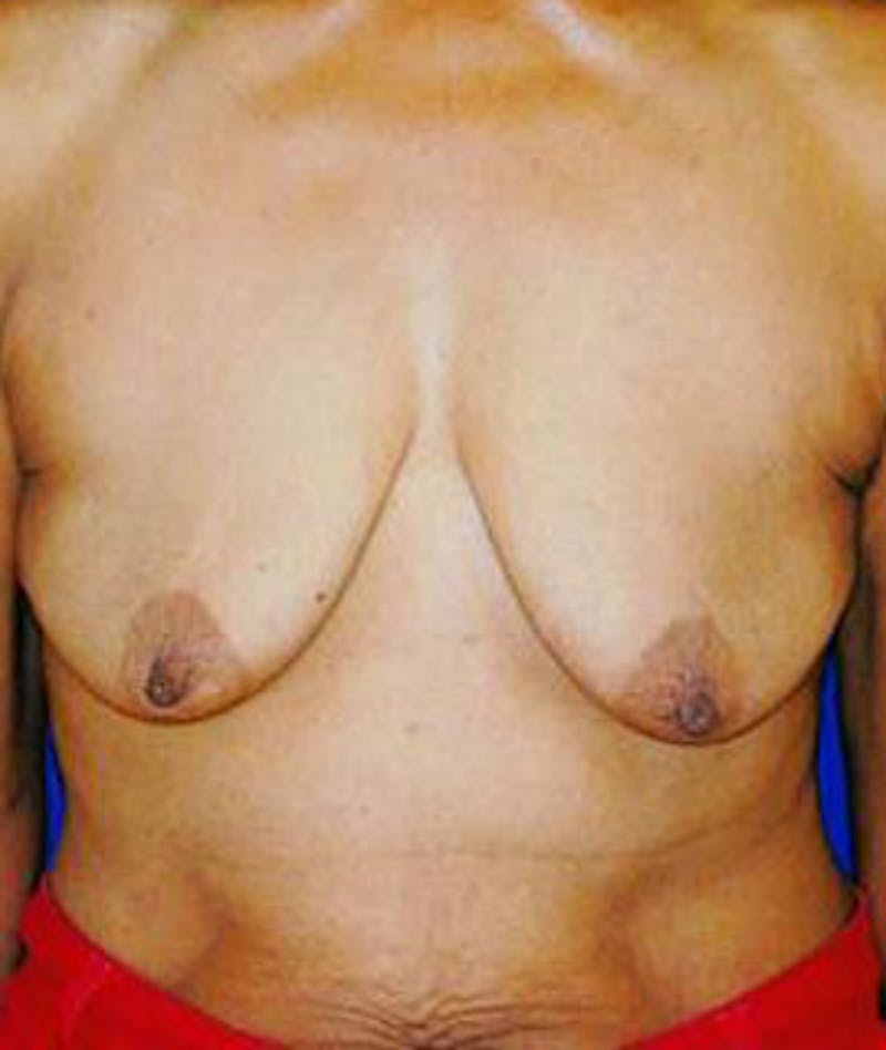 Breast Lift Before & After Gallery - Patient 116478 - Image 1