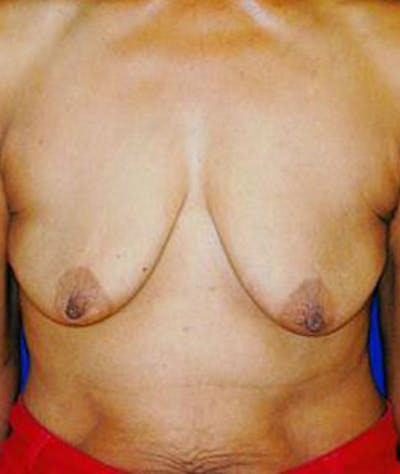 Breast Lift Before & After Gallery - Patient 116478 - Image 1
