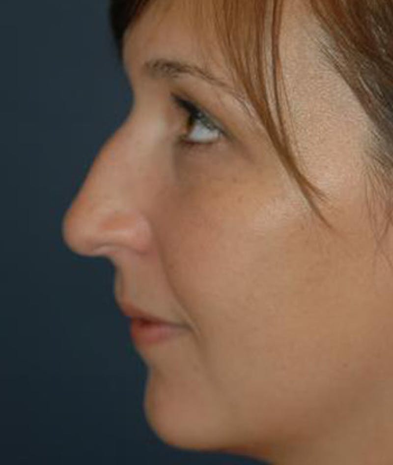 Rhinoplasty Before & After Gallery - Patient 297607 - Image 5