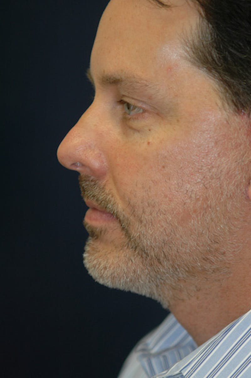 Facelift Before & After Gallery - Patient 515656 - Image 2