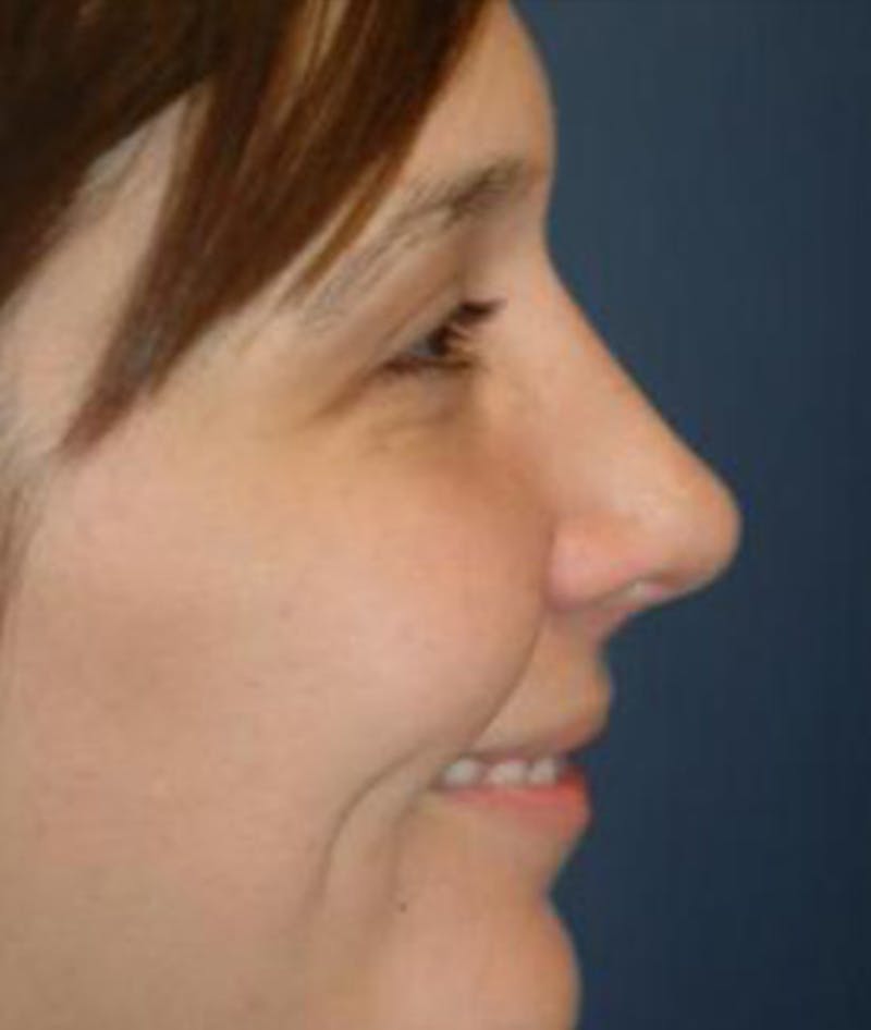 Rhinoplasty Before & After Gallery - Patient 297607 - Image 4