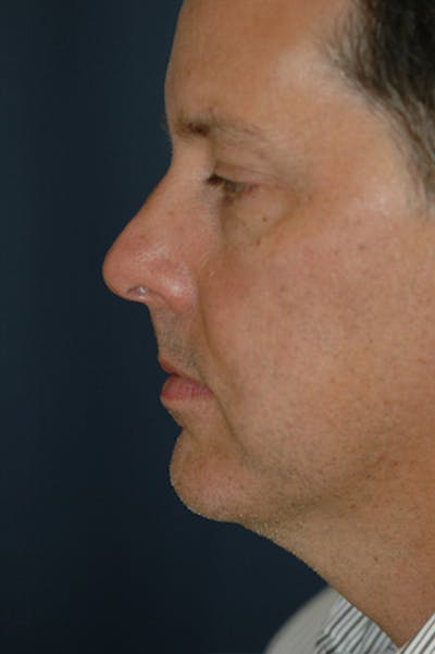 Facelift Before & After Gallery - Patient 515656 - Image 1