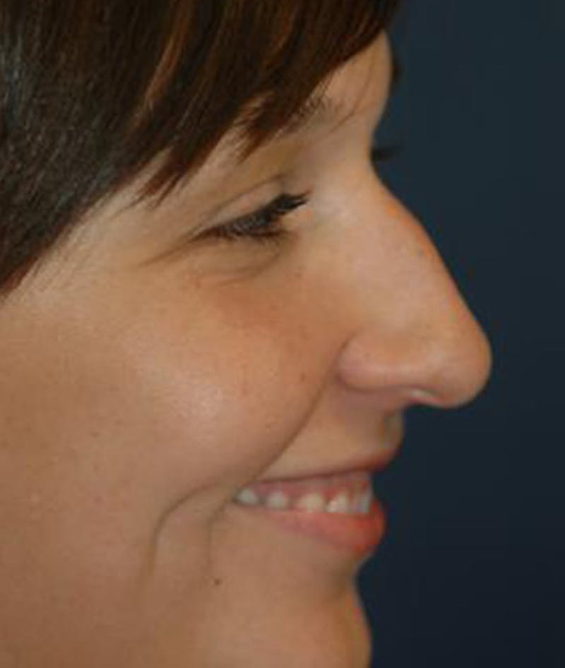 Rhinoplasty Before & After Gallery - Patient 297607 - Image 3