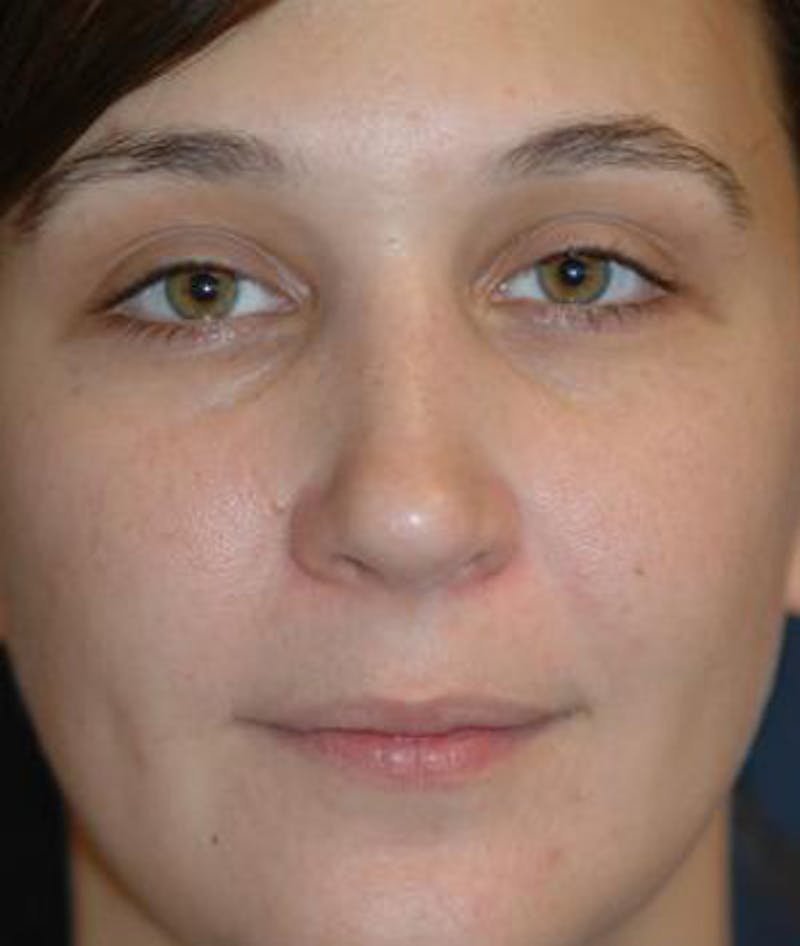 Rhinoplasty Before & After Gallery - Patient 297607 - Image 2