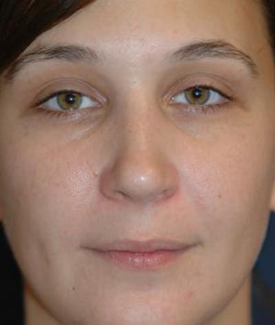 Rhinoplasty Before & After Gallery - Patient 297607 - Image 2