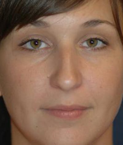 Rhinoplasty Before & After Gallery - Patient 297607 - Image 1