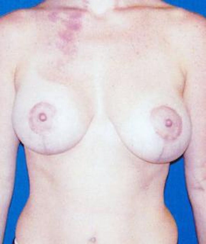 Breast Lift Before & After Gallery - Patient 323066 - Image 2