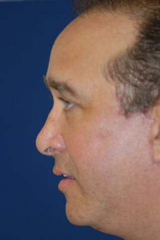 Facelift Before & After Gallery - Patient 358086 - Image 4