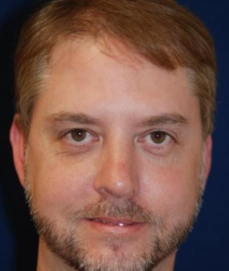Rhinoplasty Before & After Gallery - Patient 320570 - Image 6