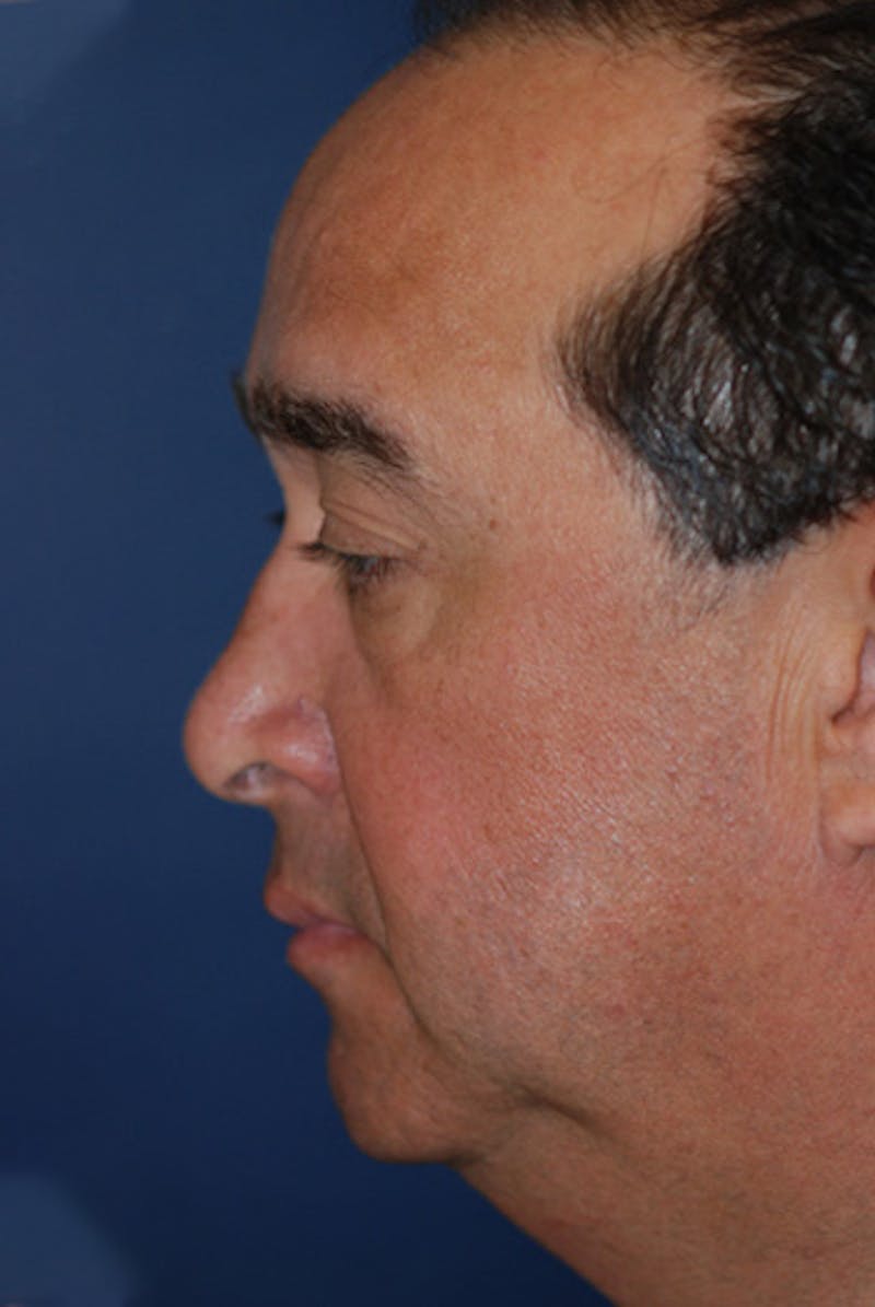 Facelift Before & After Gallery - Patient 358086 - Image 3