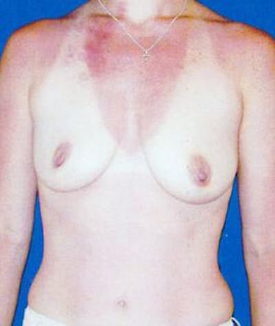 Breast Lift Before & After Gallery - Patient 323066 - Image 1
