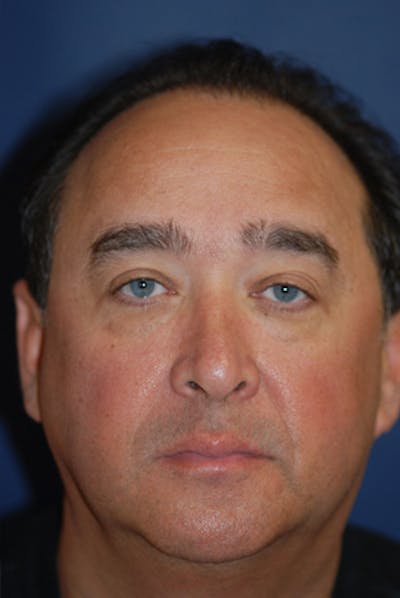 Facelift Before & After Gallery - Patient 358086 - Image 1