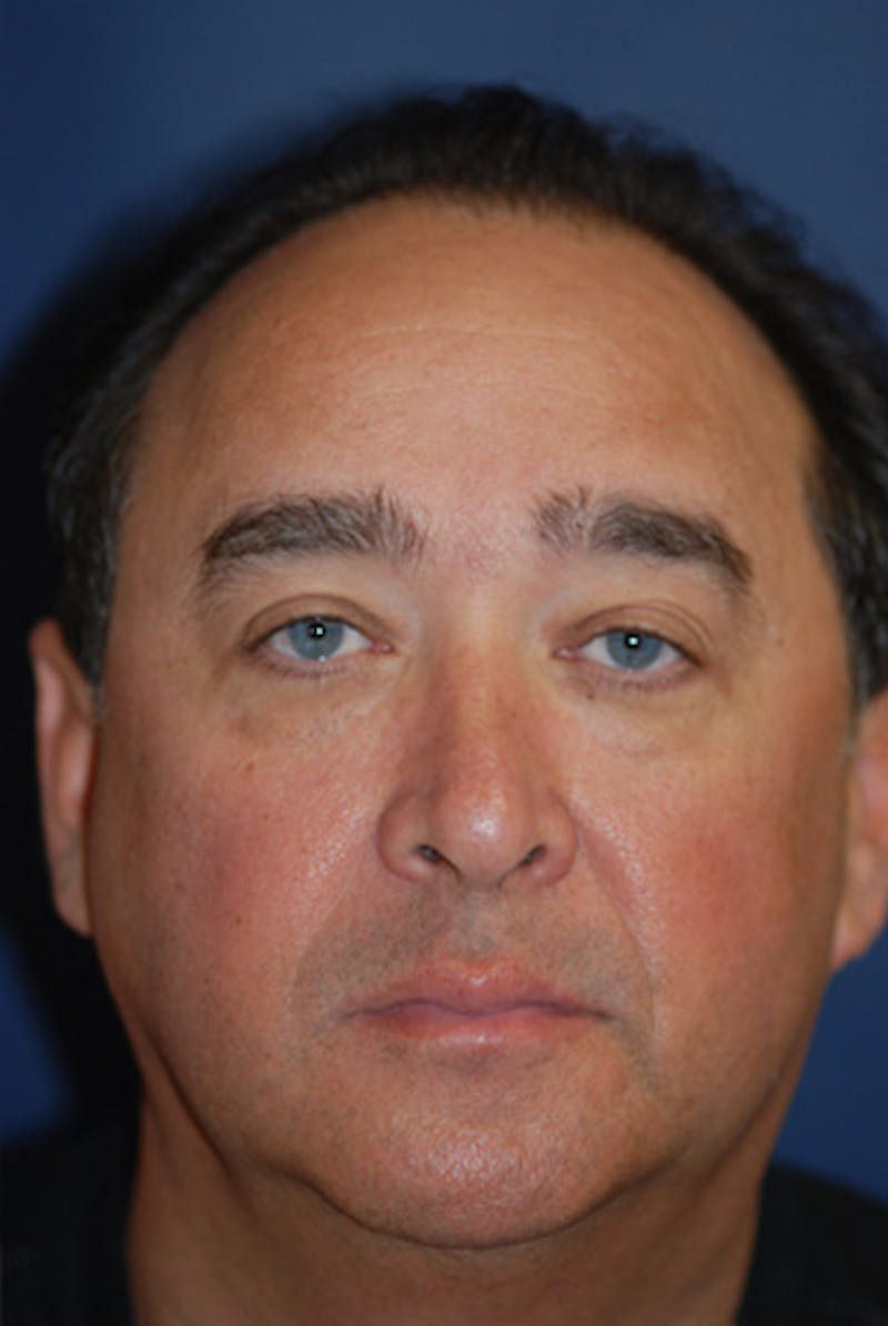 Facelift Before & After Gallery - Patient 358086 - Image 1