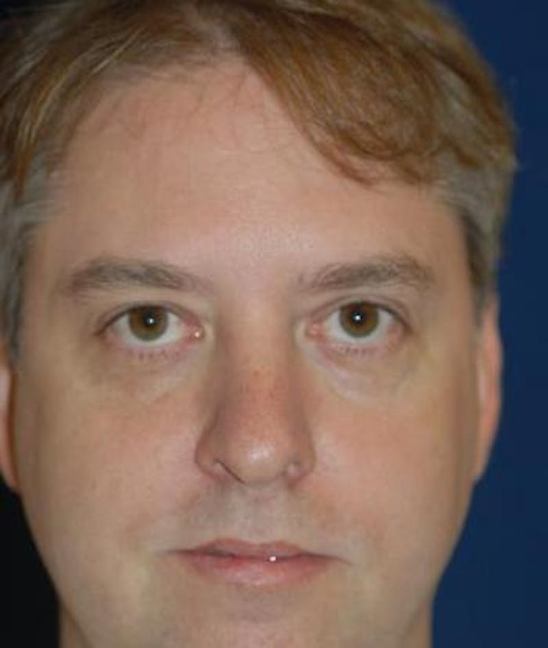 Rhinoplasty Before & After Gallery - Patient 320570 - Image 5