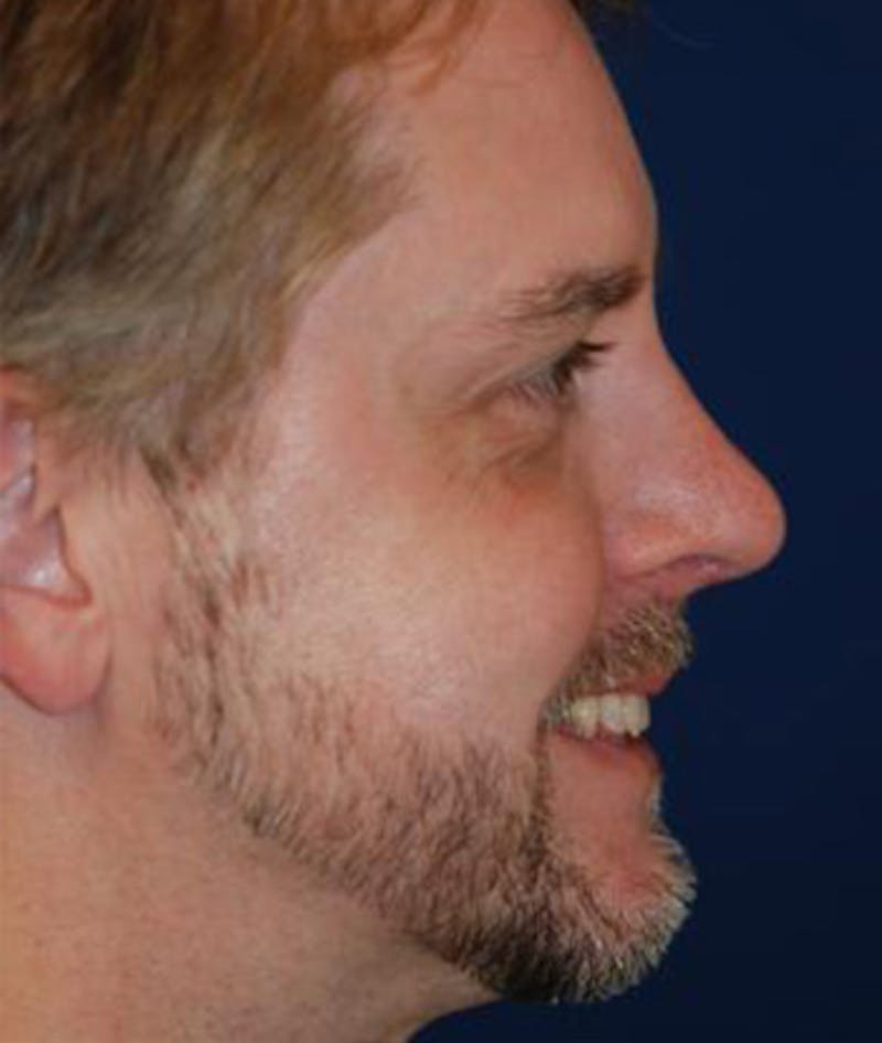 Chin Augmentation Before & After Gallery - Patient 570413 - Image 2